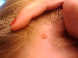 Astrology behind Moles